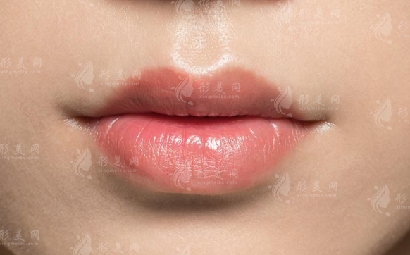 玻尿酸豐唇后唇珠太小怎么辦？