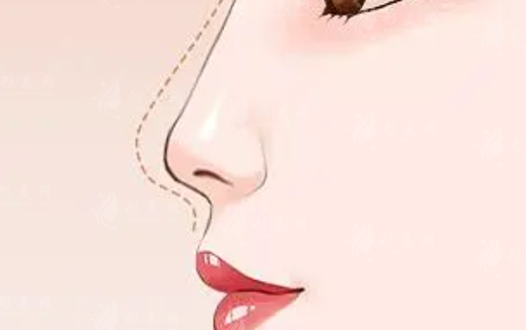 廣州軍美整形做鼻子怎么樣？醫(yī)生推薦/案例分享/價格明細(xì)查收！