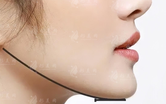 去除下頜角的方法及恢復(fù)時間