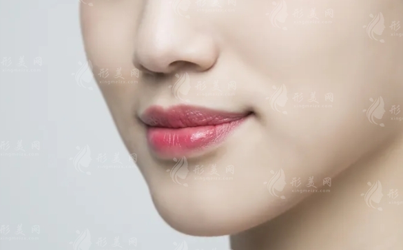 微笑唇手術(shù)效果及持久性分析