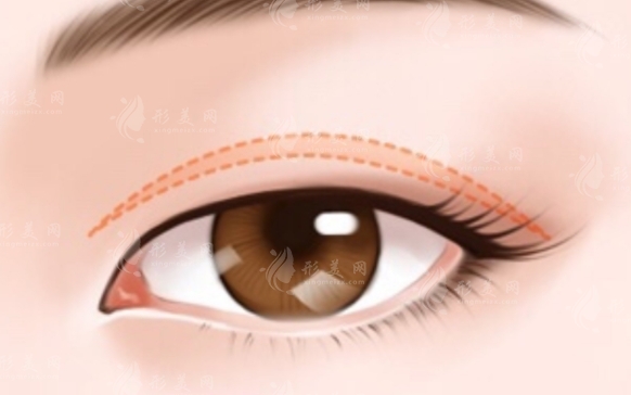 切開法重瞼術：適合人群與長期效果解析