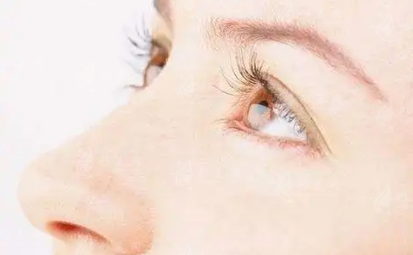 韓式無痕雙眼皮：用拆線嗎？一起來了解下