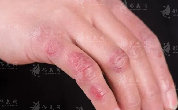 如何去除凍傷疤痕：多種方法詳解