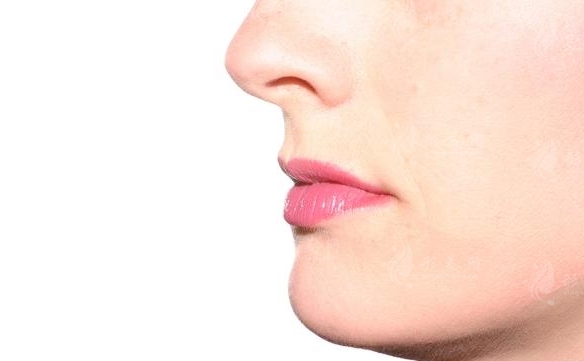 下頜角肥大整形手術(shù)詳解