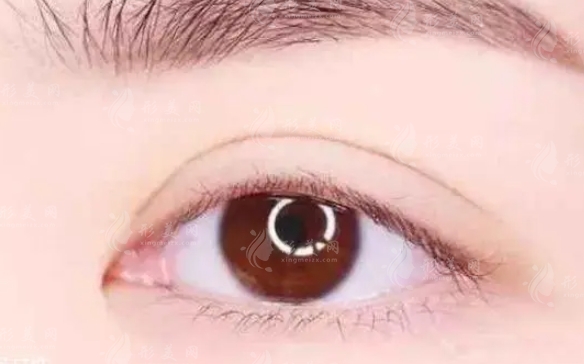 雙眼皮修復(fù)成功率高嗎？什么人適合做？