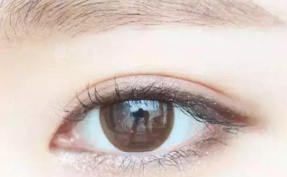 全切雙眼皮術后眼部清理的重要性