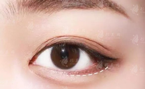 自體脂肪豐臥蠶：是否會移位及相應(yīng)措施