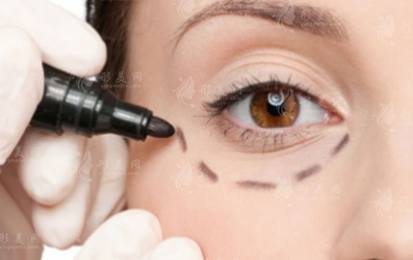 激光去眼袋:好處與壞處的全面解析 激光去眼袋:好處與壞處的全面解析