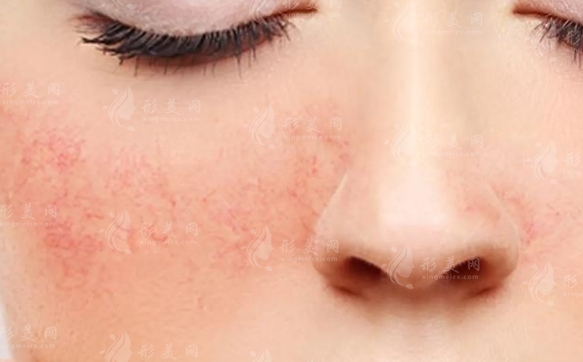 臉上角質(zhì)層薄有紅血絲：修復(fù)方法全解析