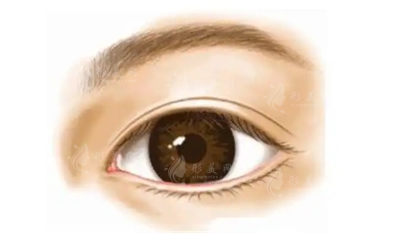 韓式三點雙眼皮恢復時間與術后注意事項