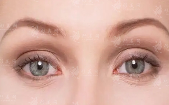 激光祛眼袋手術(shù):注意事項(xiàng)與優(yōu)勢(shì)解析 激光祛眼袋手術(shù):注意事項(xiàng)與優(yōu)勢(shì)解析