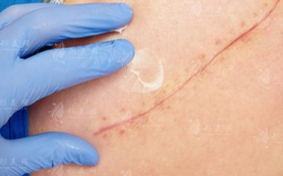 激光疤痕修復(fù)：收費(fèi)價(jià)格與術(shù)后注意事項(xiàng)