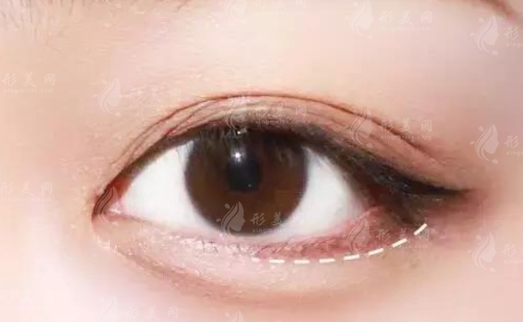 有臥蠶與無臥蠶：區(qū)別與優(yōu)勢解析