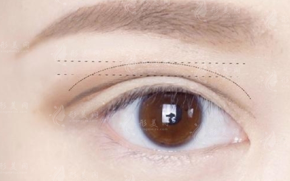 雙眼皮越寬越美麗嗎？雙眼皮的寬度應該如何衡量？