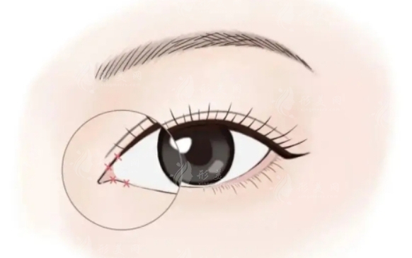 內(nèi)眼角開太大了怎么辦？內(nèi)眼角修復(fù)是否可行？