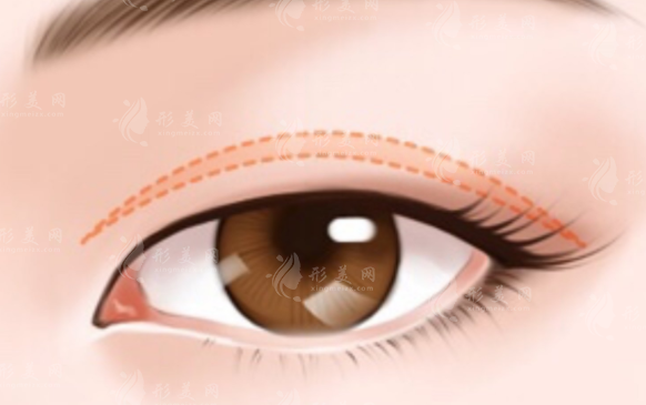 雙眼皮吸脂后，脂肪還會長嗎？會出現(xiàn)松弛嗎？