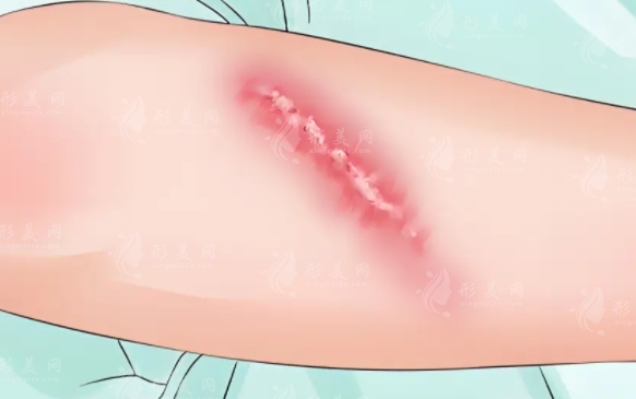 疤痕修復(fù)手術(shù)：次數(shù)與費(fèi)用詳解
