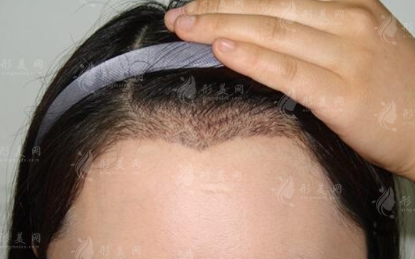 種植美人尖：價(jià)格與術(shù)后注意事項(xiàng)