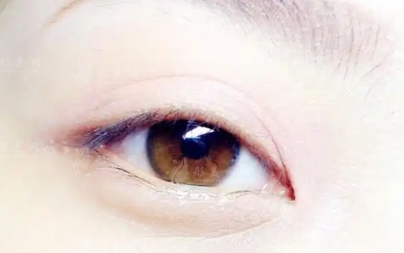 雙眼皮修復(fù)：過程、需求與切開問題解析