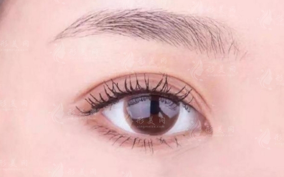 埋線后老了的危害大嗎？是否會出現(xiàn)耷拉的情況？