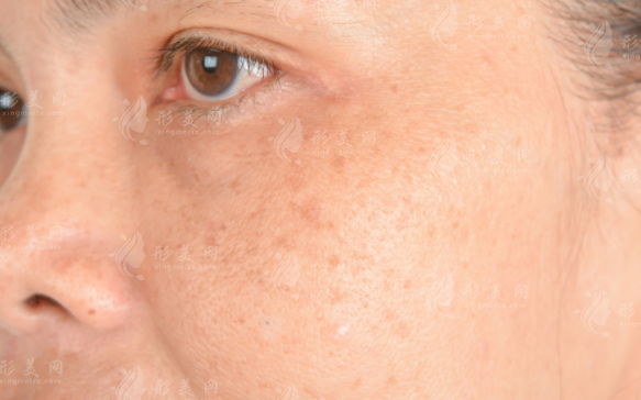  激光祛黃褐斑：告別色斑，迎接明亮肌膚