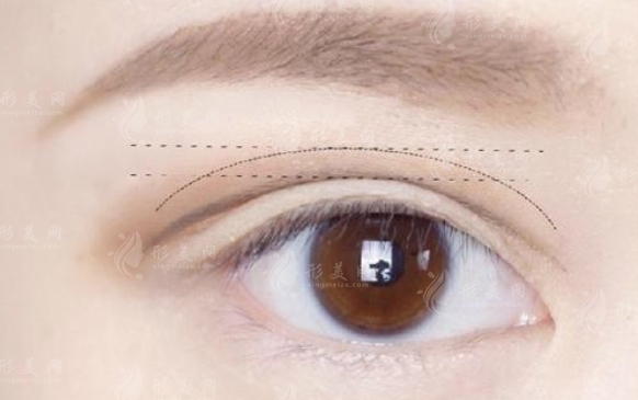 定點雙眼皮手術(shù)：了解這些缺點很重要
