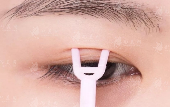 全切與埋線：雙眼皮手術(shù)的兩種選擇