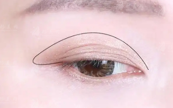 全切雙眼皮：副作用與失敗風險探討