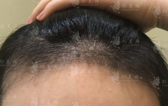 哪些因素影響自體毛發(fā)移植價(jià)格？