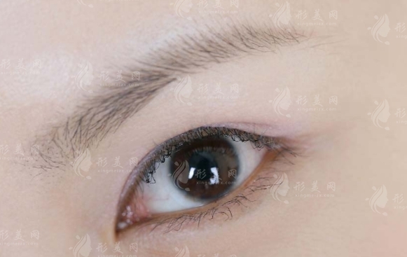 種植眉毛：優(yōu)缺點(diǎn)與費(fèi)用解析