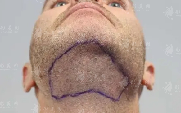 胡須移植的方法和注意事項(xiàng)