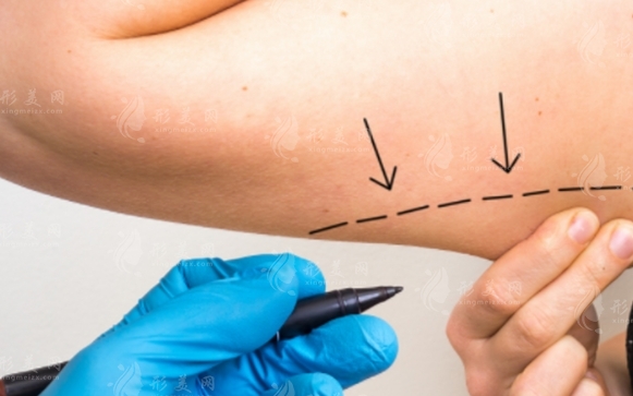 微創(chuàng)吸脂手術(shù)及其優(yōu)點