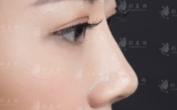 隆鼻失敗后硅膠假體的取出與恢復(fù)