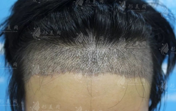 微針植發(fā)的優(yōu)勢(shì)與適應(yīng)癥