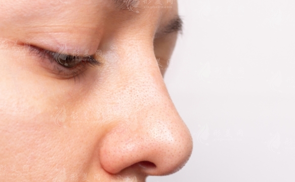 鼻翼肥厚太大怎么調(diào)節(jié)？鼻翼肥厚該如何處理？