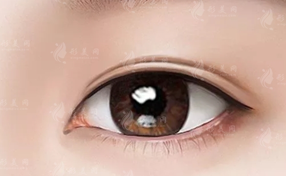 割雙眼皮眼角增生怎么辦？解決方法全解析