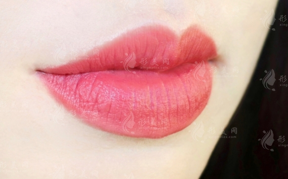 微笑唇可以保持幾年？影響因素全解析