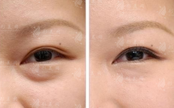 眼袋修復(fù)：并發(fā)癥與修復(fù)方法解析