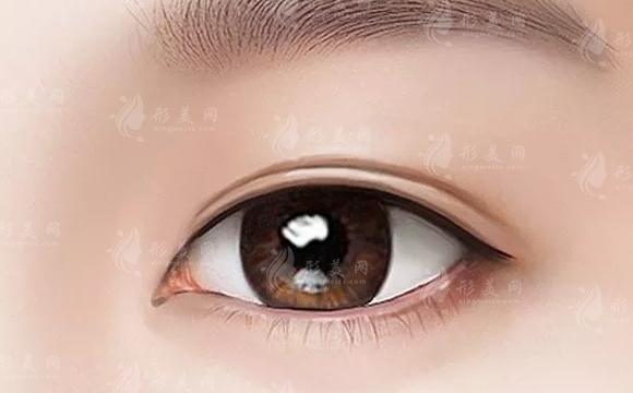 雙眼皮術(shù)：縫、割或微創(chuàng)——選擇前需深思熟慮