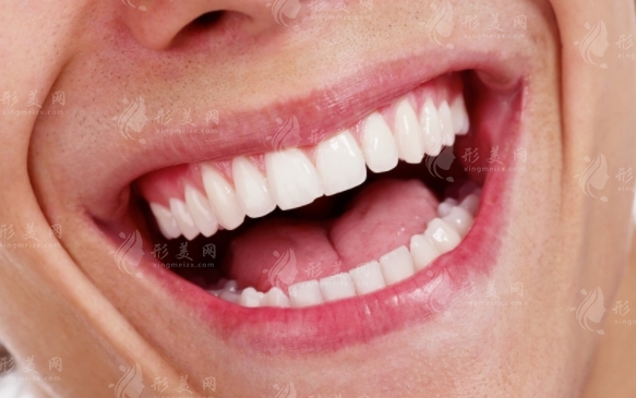 全瓷牙貼面：價格與效果維持時間