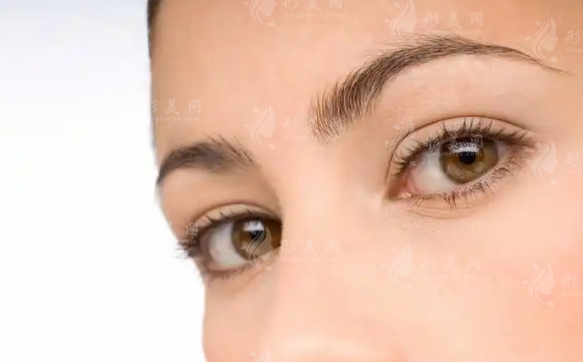 雙眼皮修復(fù)后的“肉條”及術(shù)后瘢痕增生解析