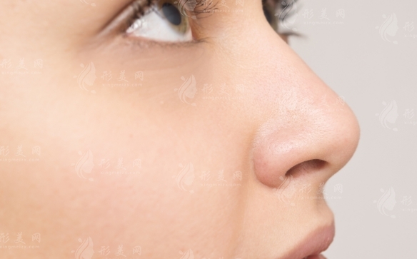 隆鼻修復(fù)過程中的關(guān)鍵注意事項