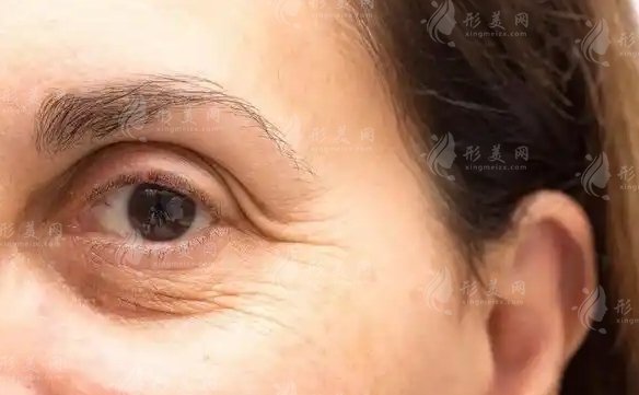 眼袋修復(fù)術(shù)的并發(fā)癥及處理辦法