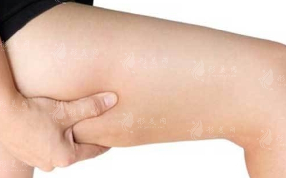大腿吸脂后出現(xiàn)肉條怎么辦？應(yīng)該怎么避免？