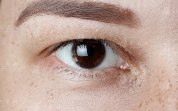 射頻去眼袋：有效性與費(fèi)用探討