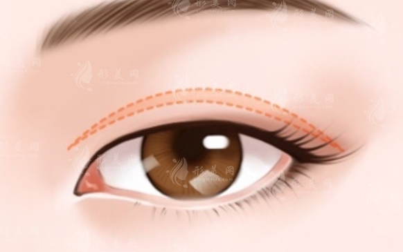 全切雙眼皮手術(shù)后兩側(cè)不一樣怎么辦？