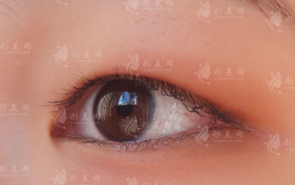 腫泡眼與傳統(tǒng)雙眼皮手術(shù)的挑戰(zhàn) 腫泡眼與傳統(tǒng)雙眼皮手術(shù)的挑戰(zhàn)