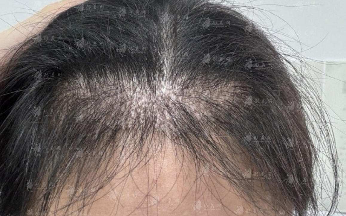 毛發(fā)移植：靜待時(shí)光，見(jiàn)證新生的奇跡