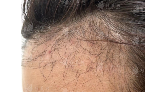 頭發(fā)移植：效果維持與潛在缺點(diǎn)解析