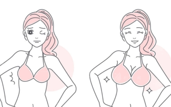 隆胸假體材料需根據(jù)年齡選擇嗎？術(shù)后注意事項一覽